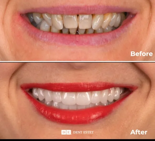 before-after-reabilitare-orala-completa
