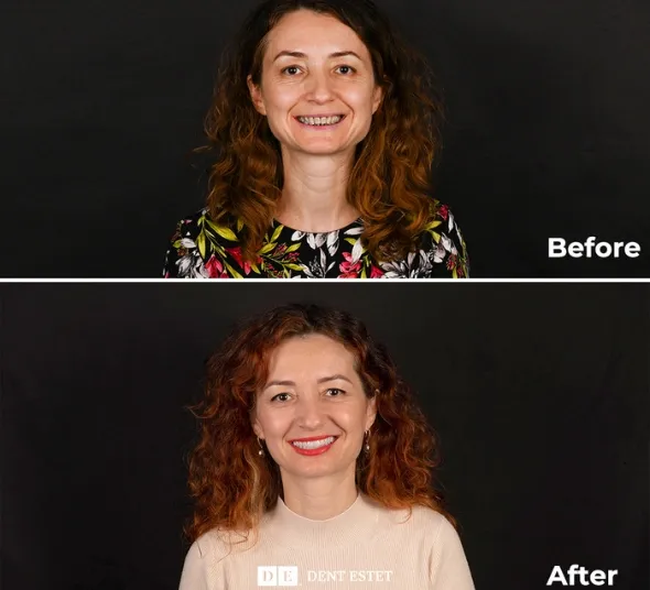 rezultat-final-straumann-pro-arch-dent-estet