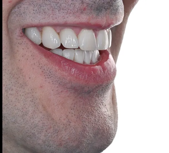 zambet-dupa-aparat-dentar-ceramic