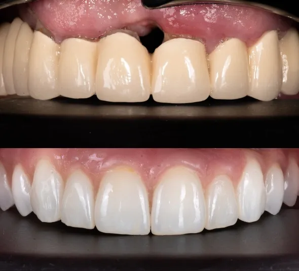 implanturi dentare de tip all-on-4