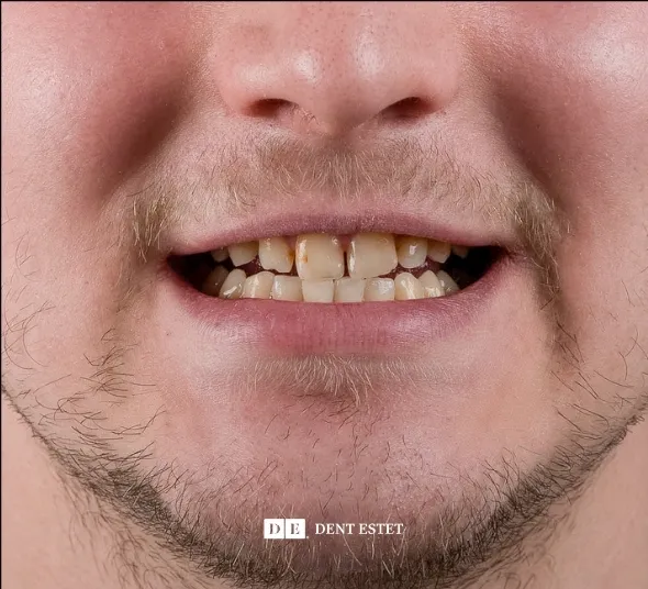 DENT ESTET
