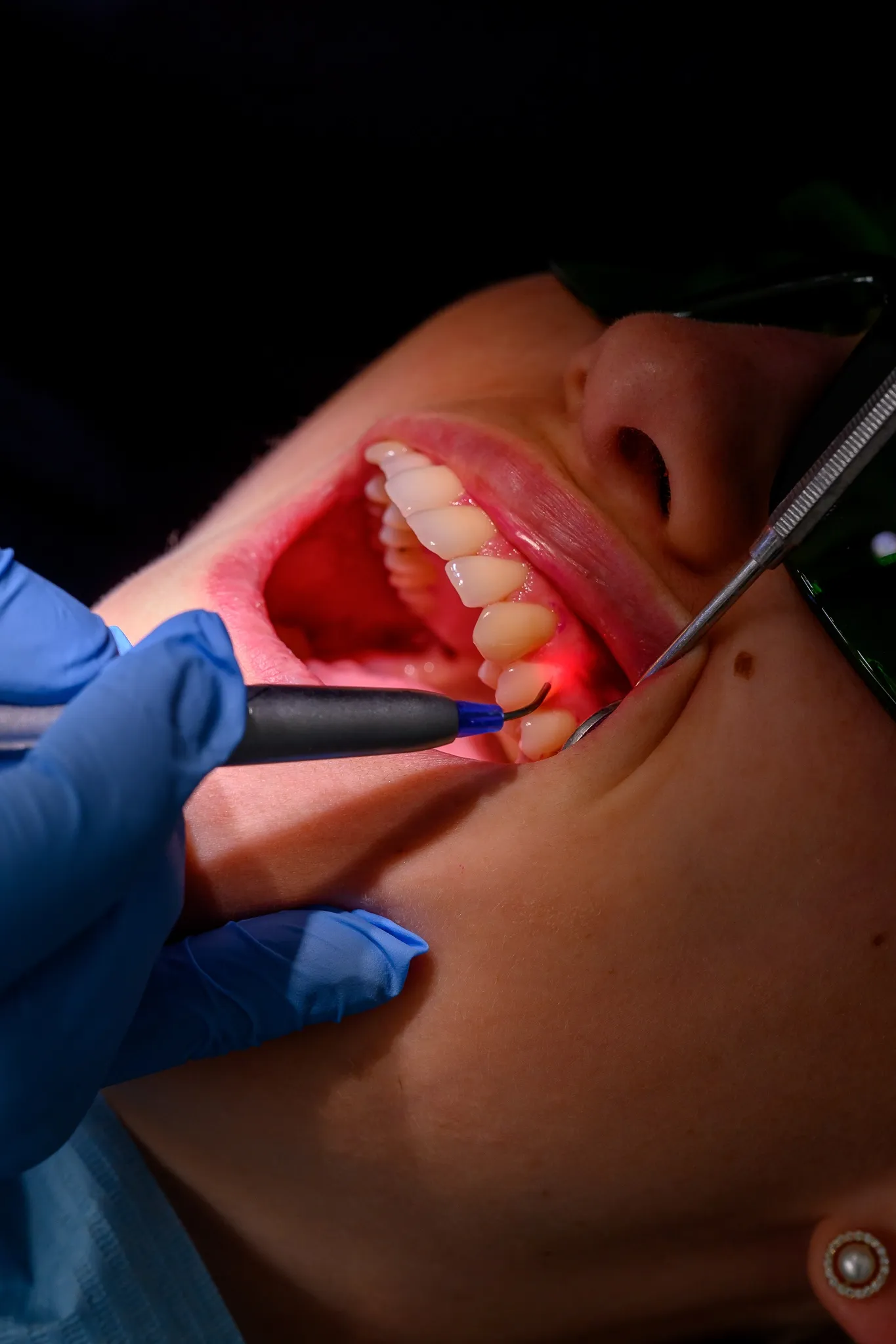 Laserul dentar Biolase Waterlase este folosit în tratamentul bolii parodontale.
