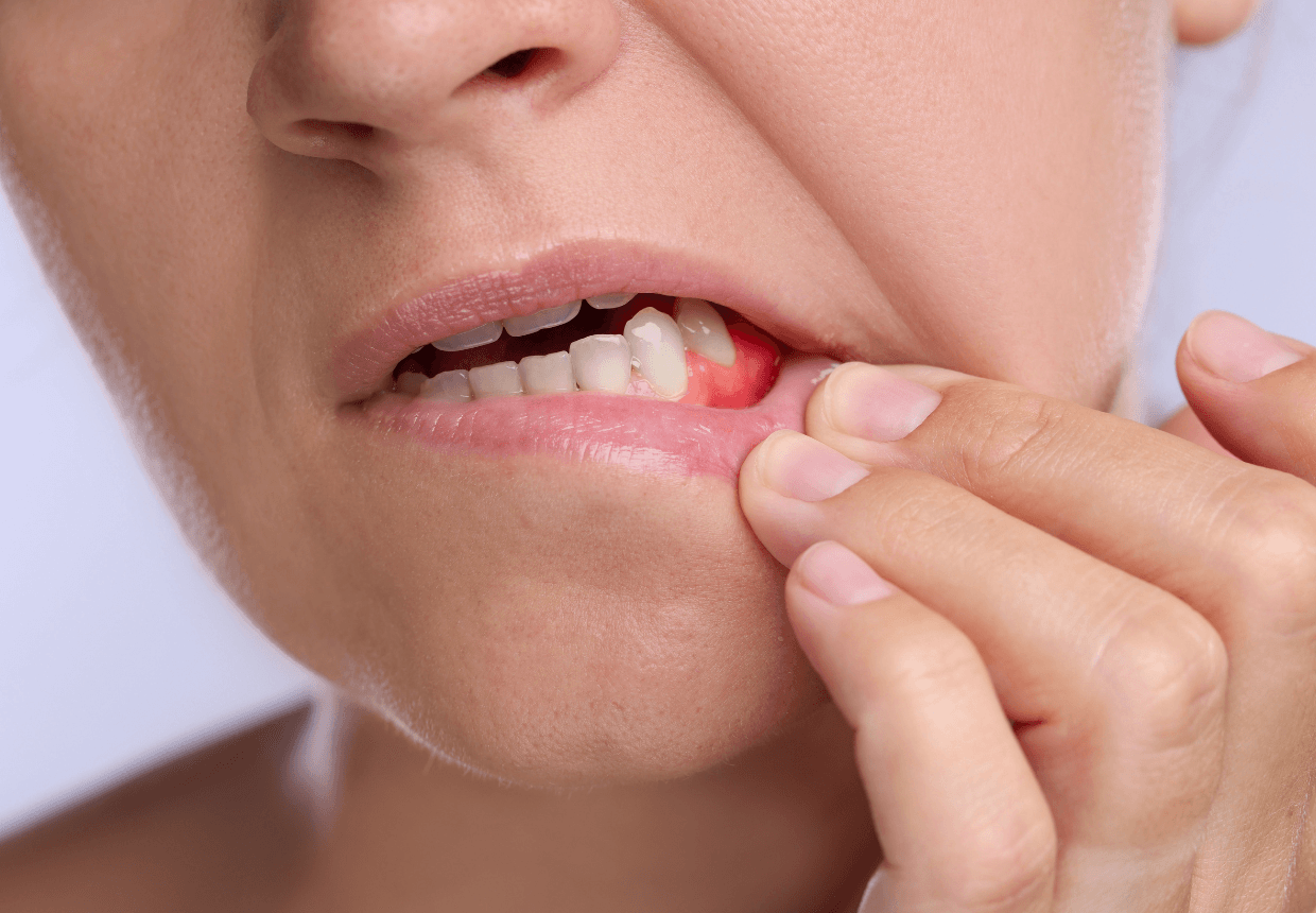 Abces gingival – simptome