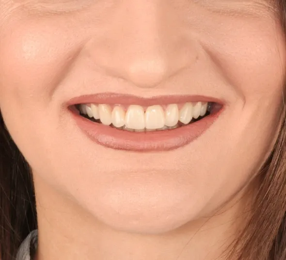 Zâmbet după tratament cu fațete dentare EMAX și coroană pe implant dentar realizat la DENT ESTET Brașov