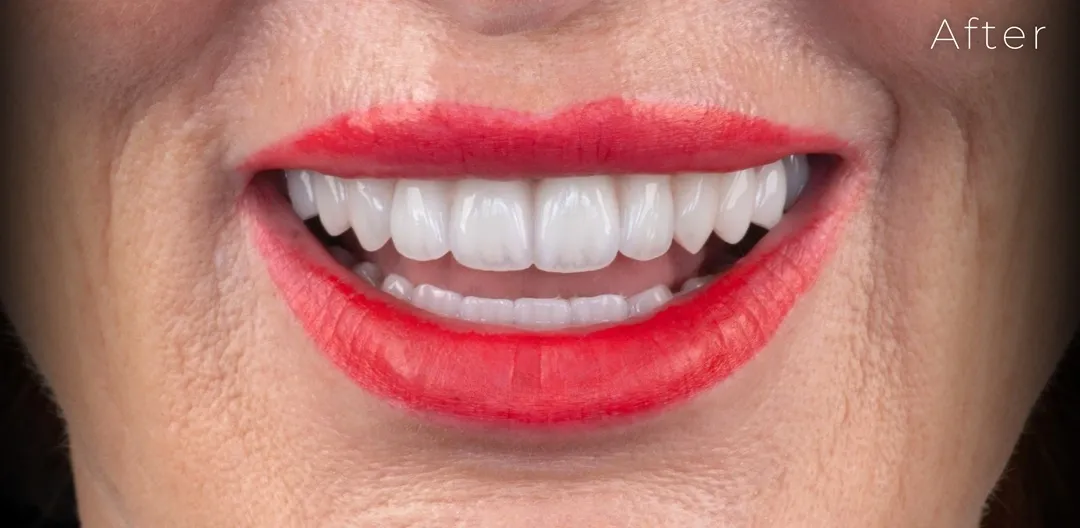 after-fatete-dentare-pacient-dent-estet.webp