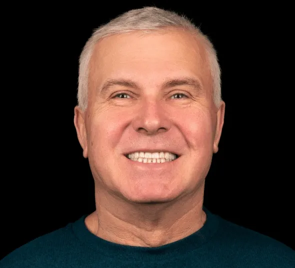 Alexandru I | Portret dupa tratament cu implant dentar si fatete Emax