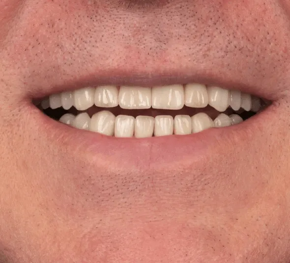 Alexandru I | Zambet dupa tratament cu implant dentar si fatete Emax