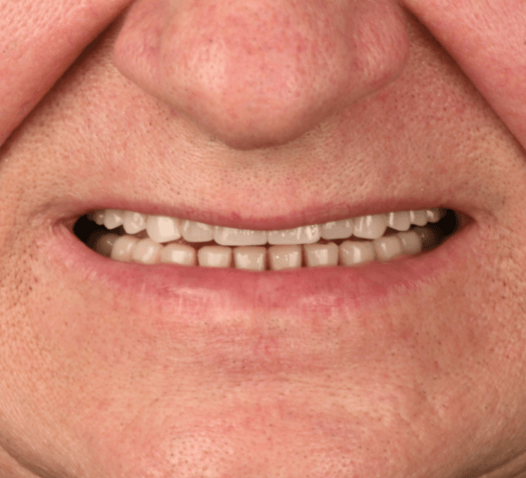 Zâmbet după tratamentul cu implant dentar Straumann® Pro Arch și lucrare fixă pe implanturi
