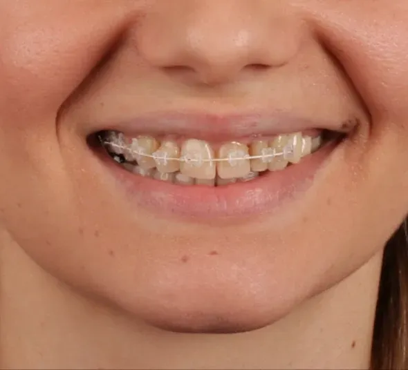 Zâmbetul Sorinei în timpul tratamentului ortodontic cu aparat dentar ceramic