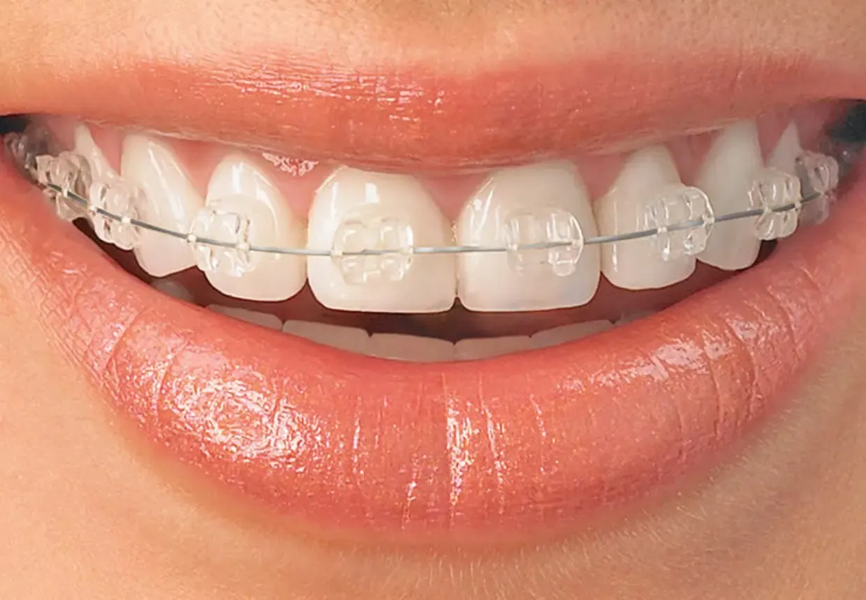Aparat dentar safir
