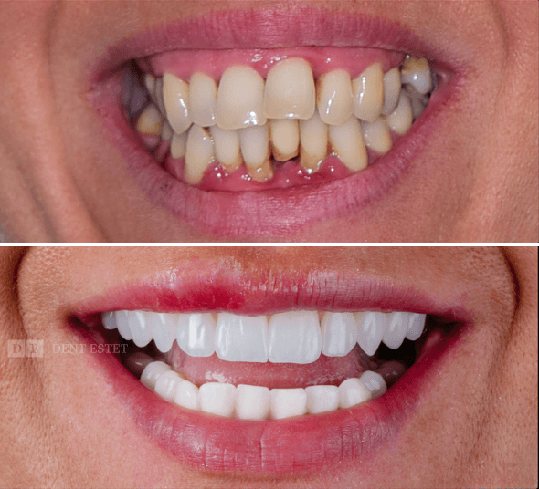 Before & After Mihaela K. – transformarea zâmbetului prin tratamentul All-on-4 cu implanturi dentare și lucrări fixe realizate la DENT ESTET.