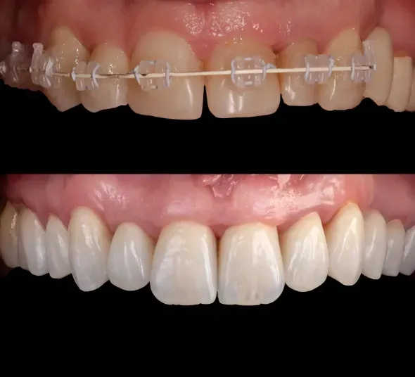 Before & After: arcada superioară cu aparat dentar ceramic și rezultatul după restaurarea cu fațete E.MAX
