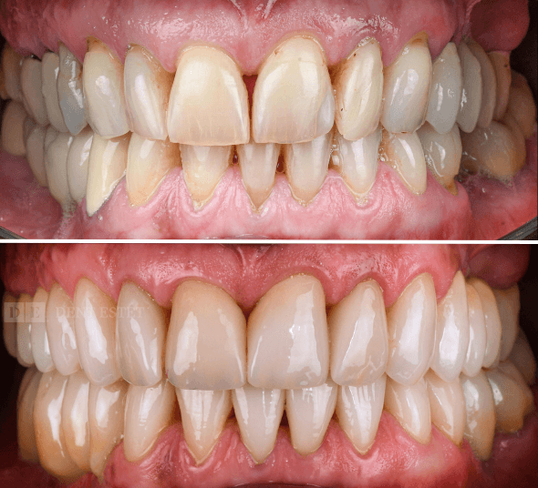 Before & After fațete dentare EMAX și coroane premium – transformarea zâmbetului pacientei Georgeta F.