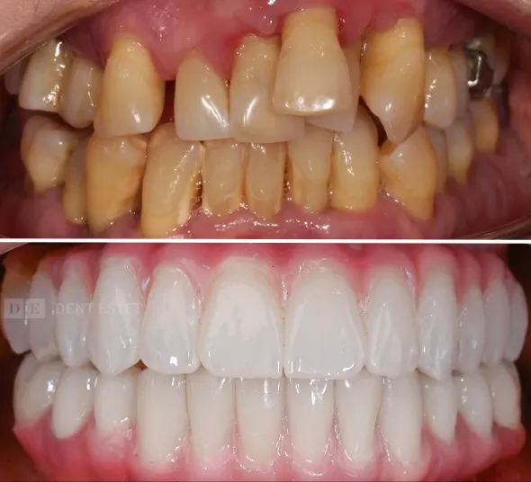 Before & After implant dentar All-on-4® – transformarea zâmbetului pacientei Anca G.