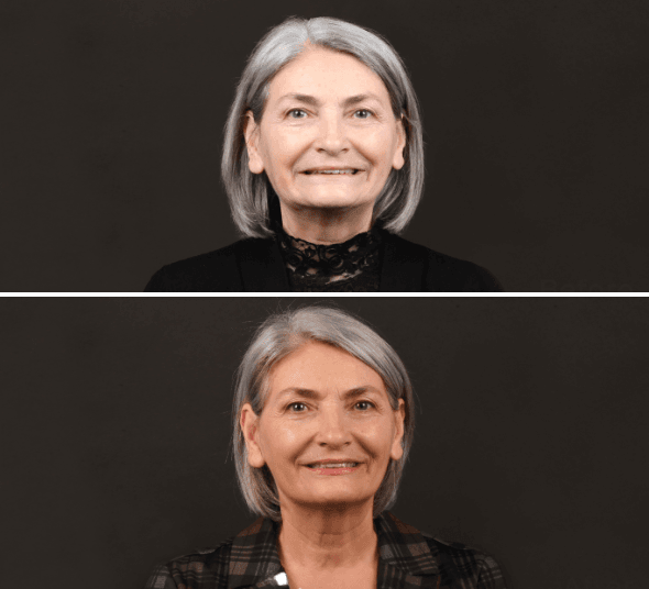Before & After implant dentar Straumann® Pro Arch – transformarea zâmbetului pacientei Maria O.