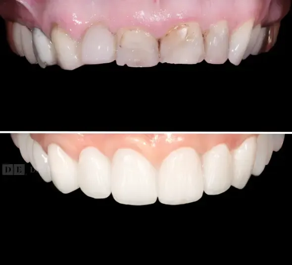 Before & After implant dentar, coroane dentare ceramice și fațete EMAX