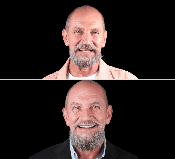 Before & After: rezultatul tratamentului cu implanturi dentare, All-on-4® și coroane premium pentru pacientul Vasile P.