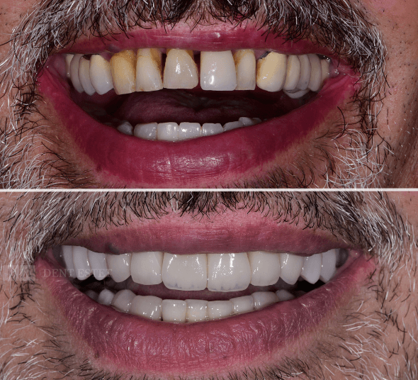 Costică C. - Before & After reabilitare orală completă cu fațete EMAX, coroane din zirconiu și implanturi Straumann®.