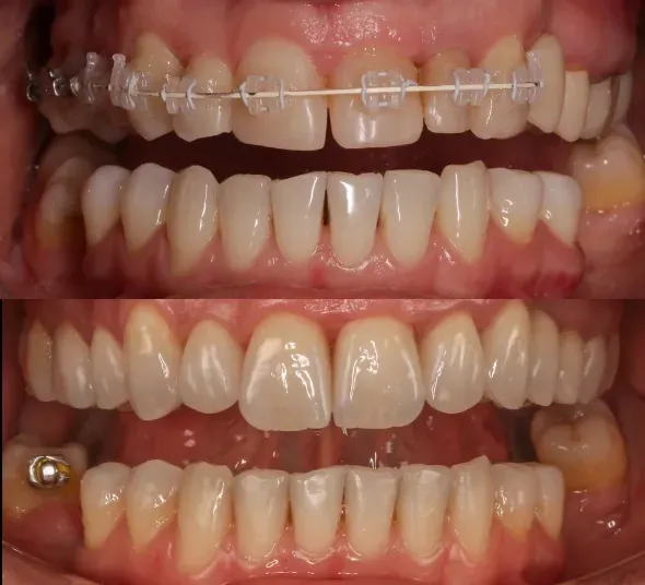 Comparație intraorală înainte și după tratamentul ortodontic și restaurările dentare