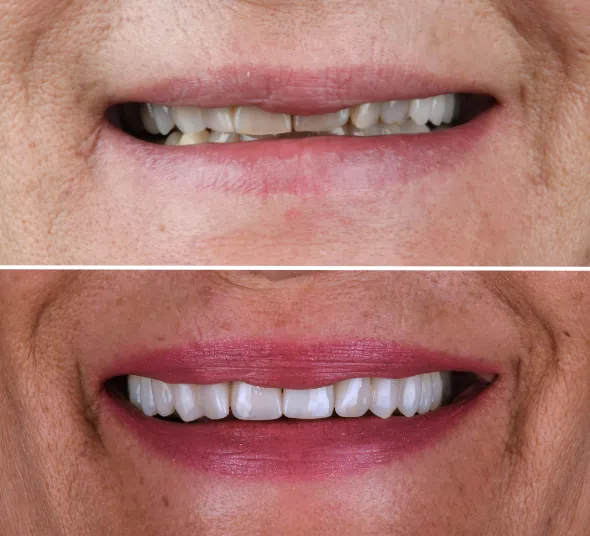 Rezultat înainte și după tratamentul cu fațete dentare EMAX și coroane premium