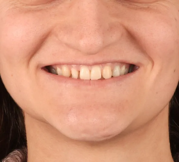 Zâmbet înainte de tratamentul cu fațete dentare EMAX și coroană pe implant dentar