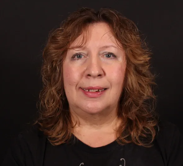 Pacienta Anca G. înainte de tratamentul cu implant dentar All-on-4®