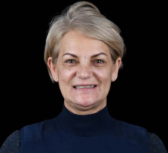 Pacienta Georgeta F. înainte de tratamentul cu fațete dentare EMAX și coroane premium