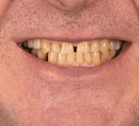 Alexandru I | Zambet inainte de tratament cu implant dentar si fatete Emax