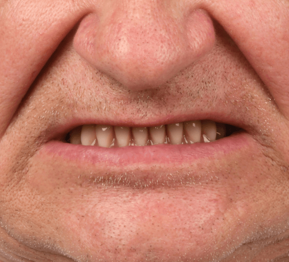 Zâmbet înainte de tratamentul cu implant dentar Straumann® Pro Arch