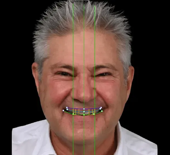 Portret pacient înainte de tratament cu fațete dentare.