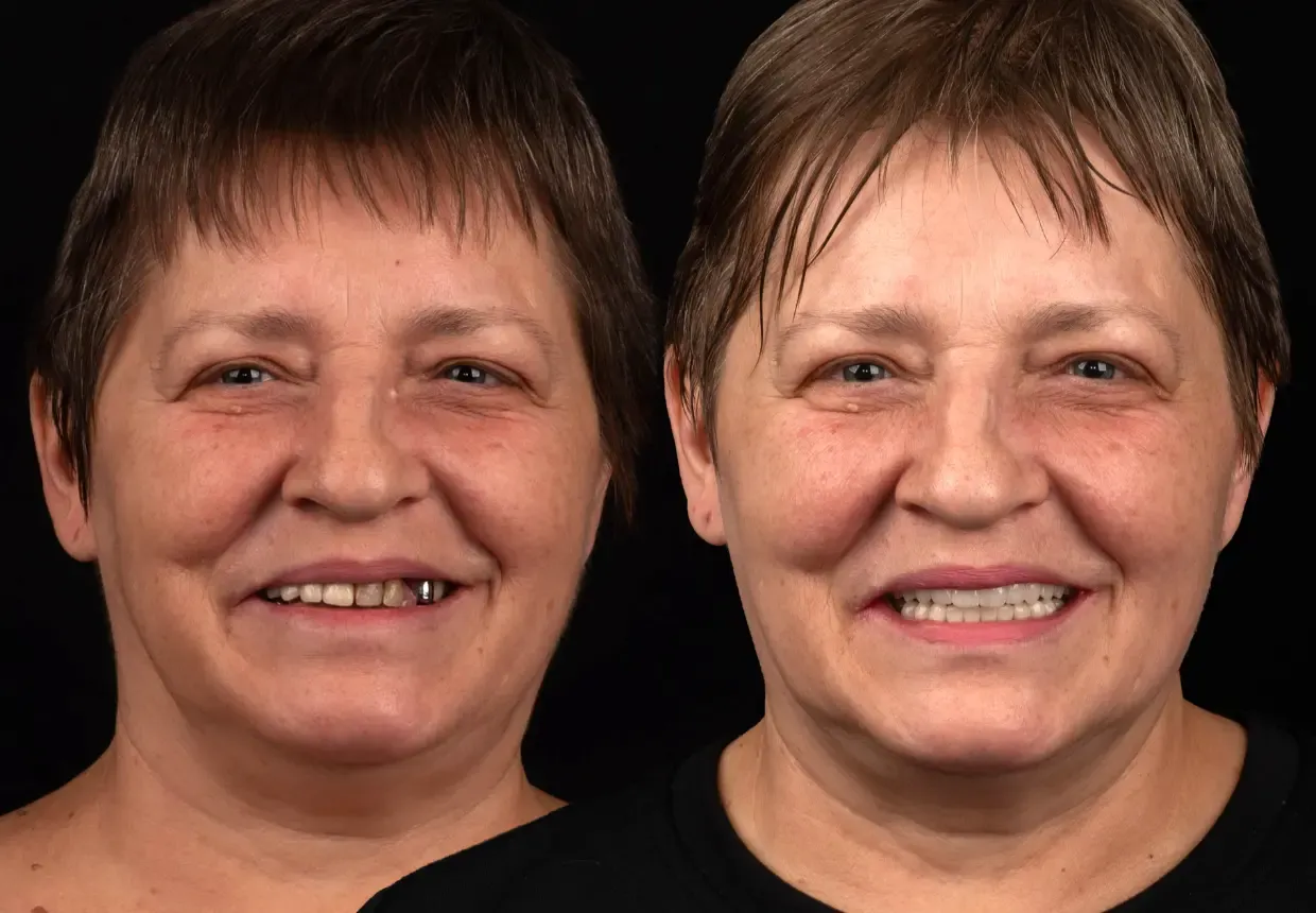 Caz înainte și după – pacientă cu dinți ficși în 24 de ore