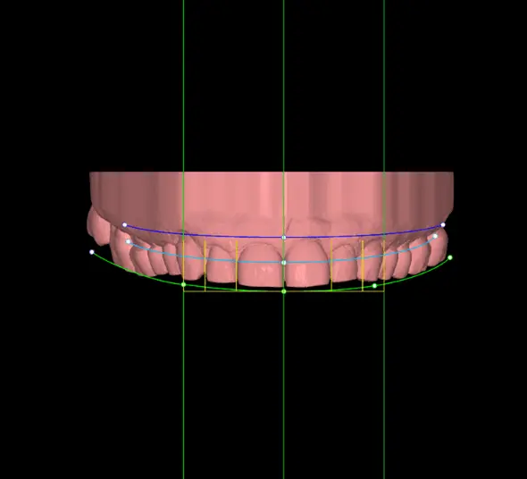 Randare dinți superiori înainte de tratament cu fațete dentare ceramice.