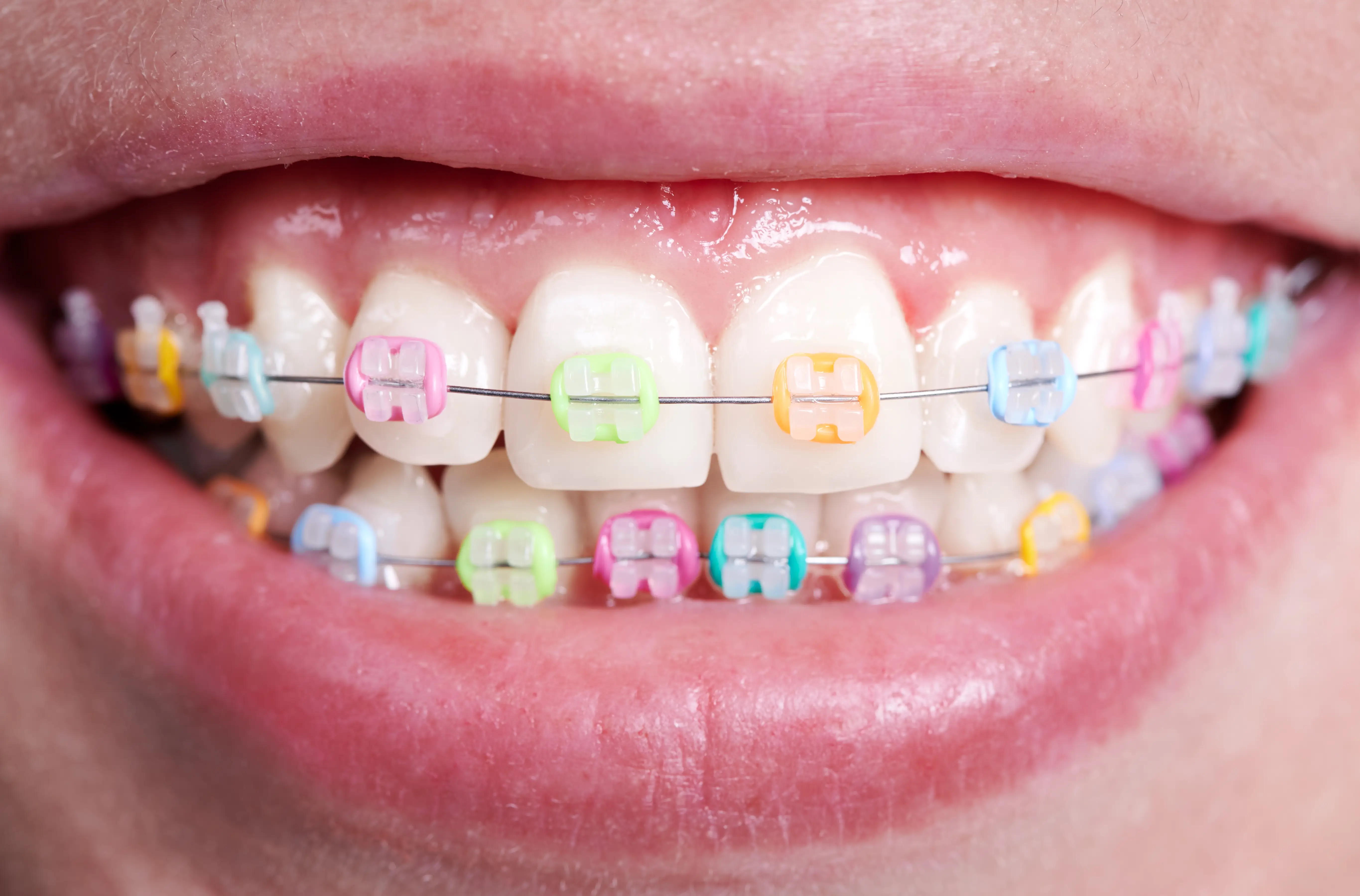 Smile with fixed ceramic braces and coloured bands.