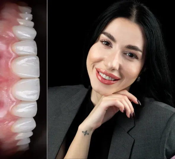 Transformare cu fatete dentare ceramice EMAX | Alexandra R