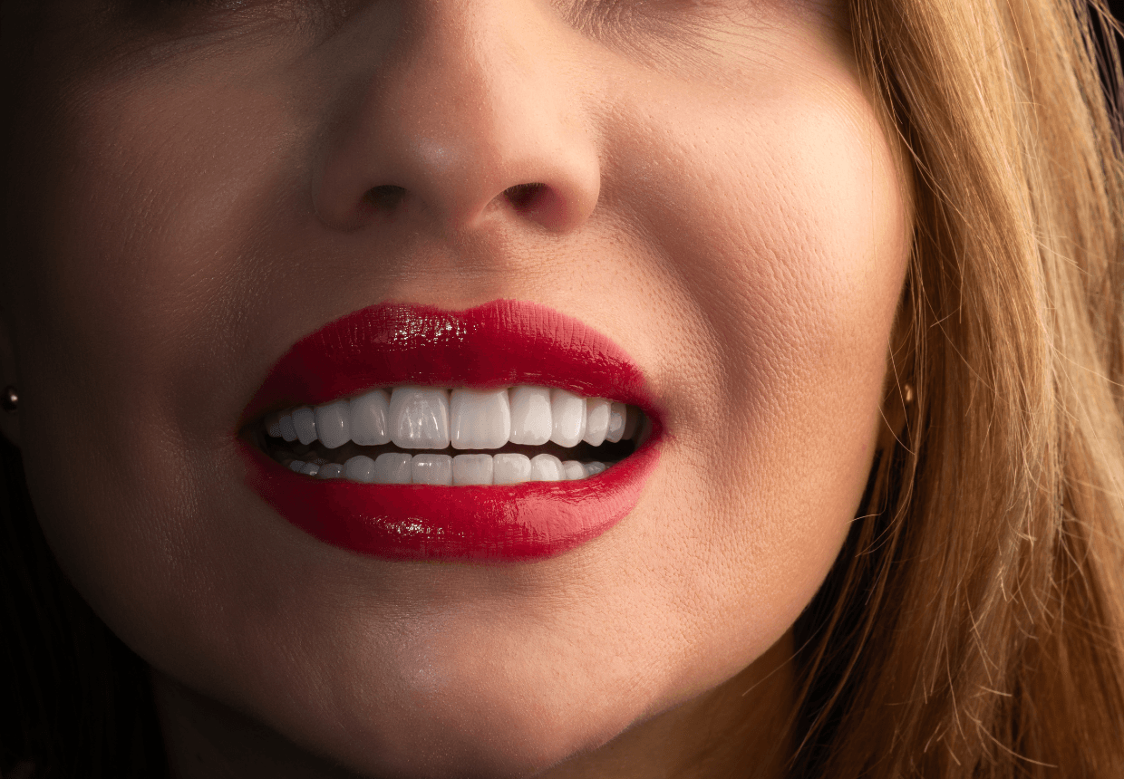 Pacienta DENT ESTET cu fatete dentare ceramice