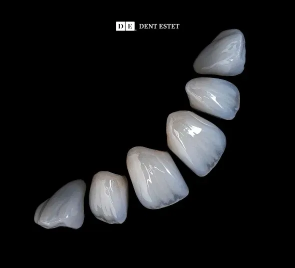 Fatete dentare ceramice EMAX | Caz Before & After