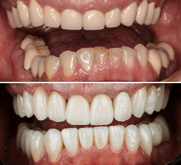 Before & After fațete dentare EMAX și coroane premium din zirconiu realizate la DENT ESTET Sibiu