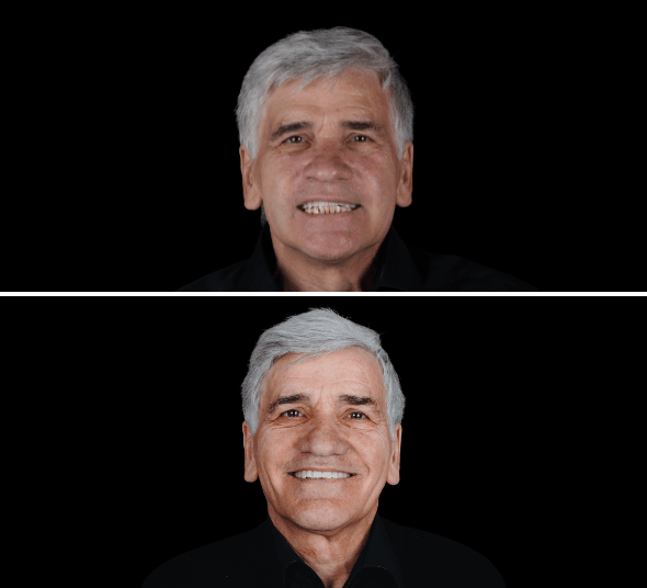 Pacient după tratamentul cu implant dentar All-on-4 și lucrare fixă pe implanturi