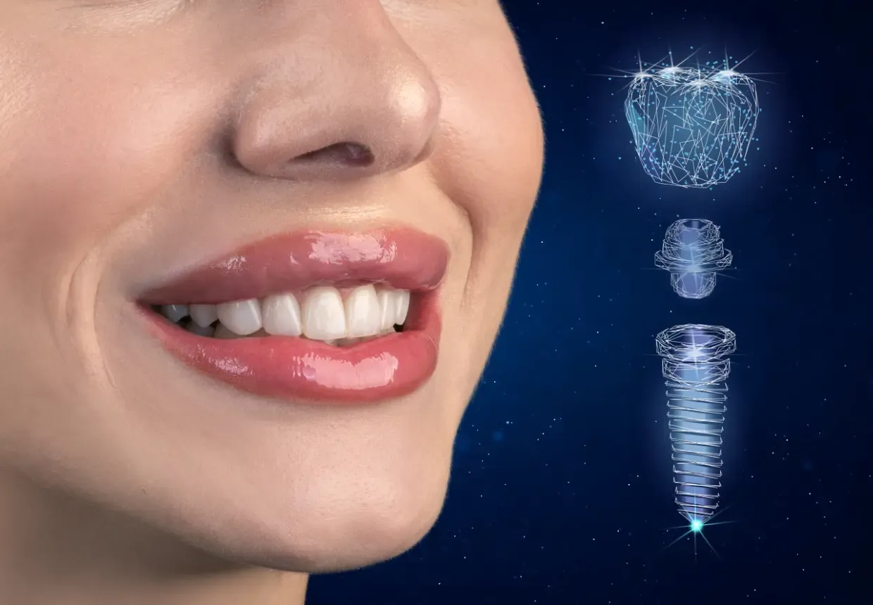 Implant dentar cu AI