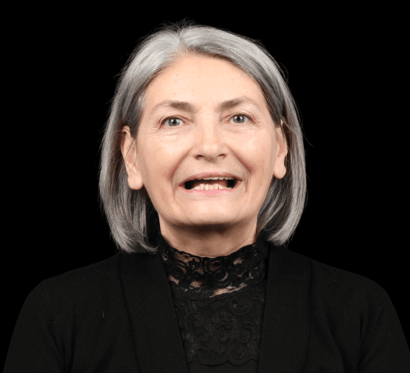 Pacienta Maria O. înainte de tratamentul cu implant dentar Straumann® Pro Arch