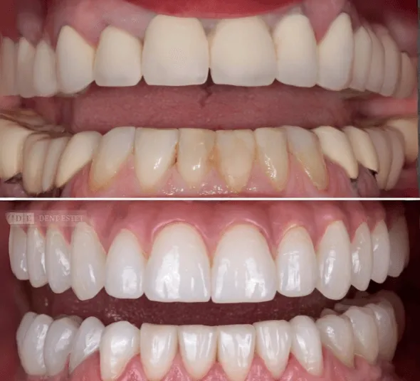 Comparatie fotografii intraorale inainte si dupa implant dentar All-on-4