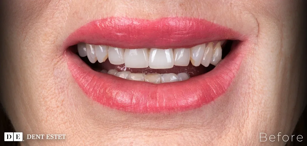inainte-fatete-dentare-pacient-dent-estet.webp