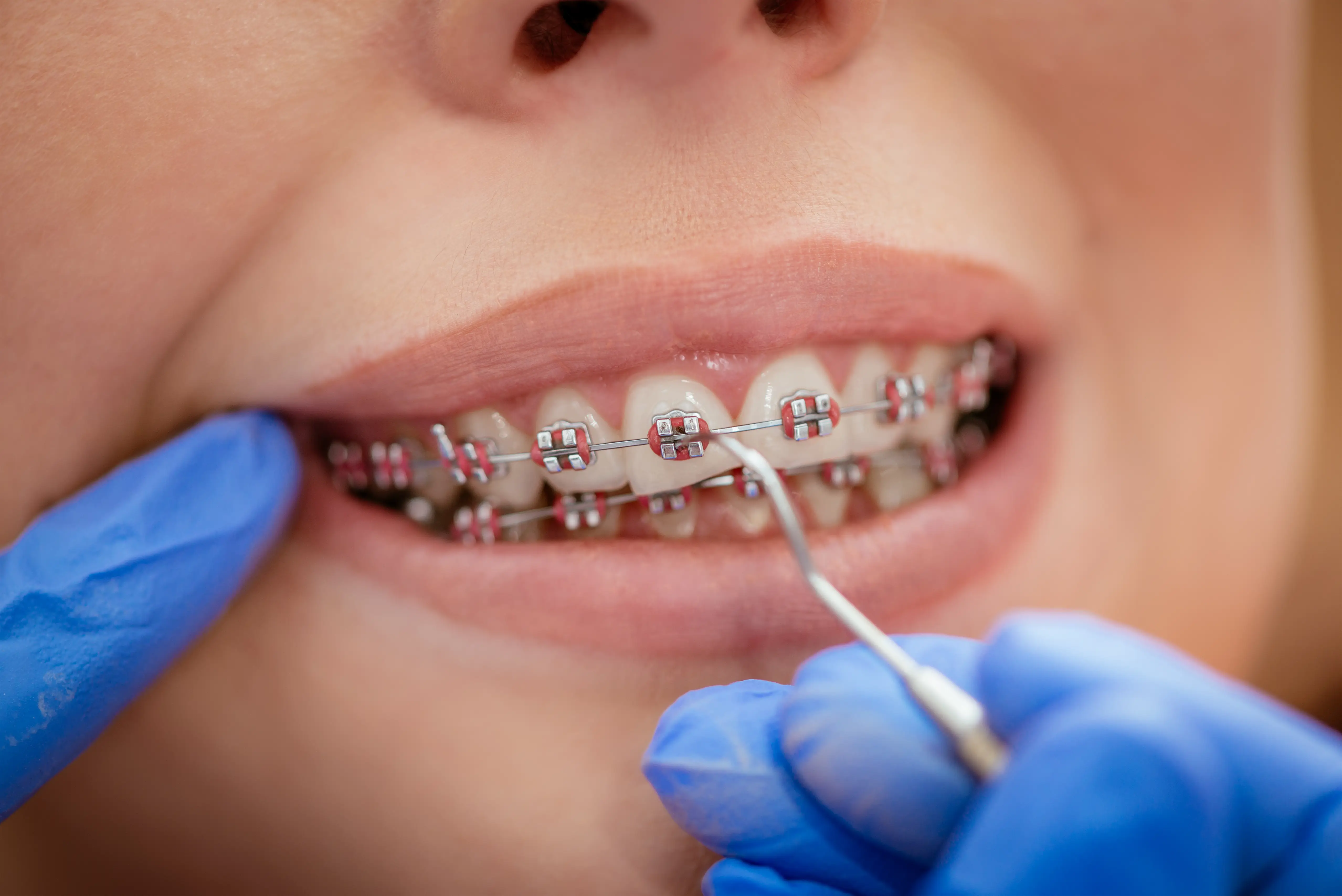 Patient with metal braces and pink bands getting a check-up.