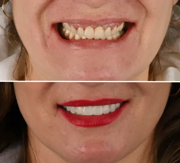 Pacientă înainte și după implant dentar Straumann, reabilitare protetică și regenerare osoasă.