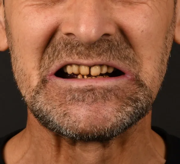 DENT ESTET