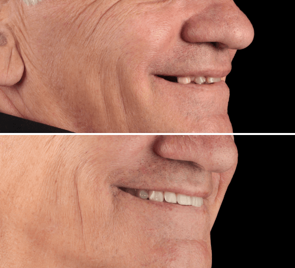 Profilul pacientului după tratamentul cu implant dentar All-on-4 și restaurare fixă