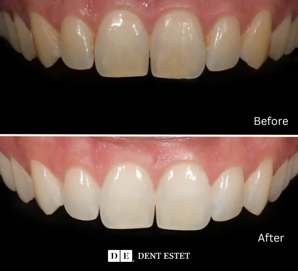 DENT ESTET