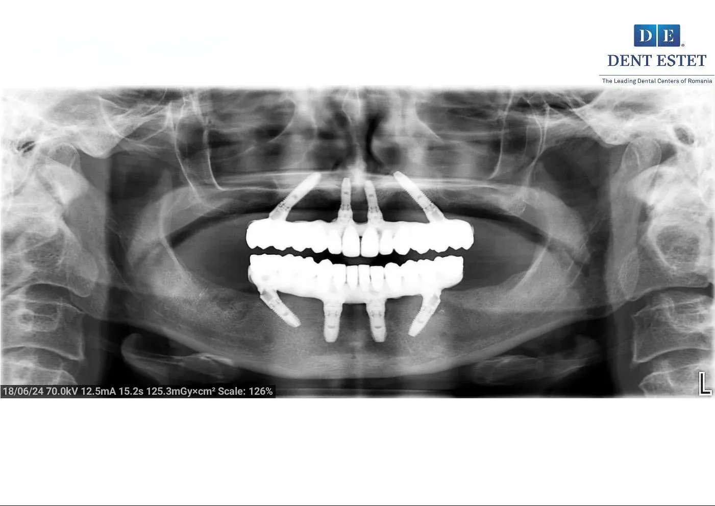 radiografie-dupa-all-on-4.webp