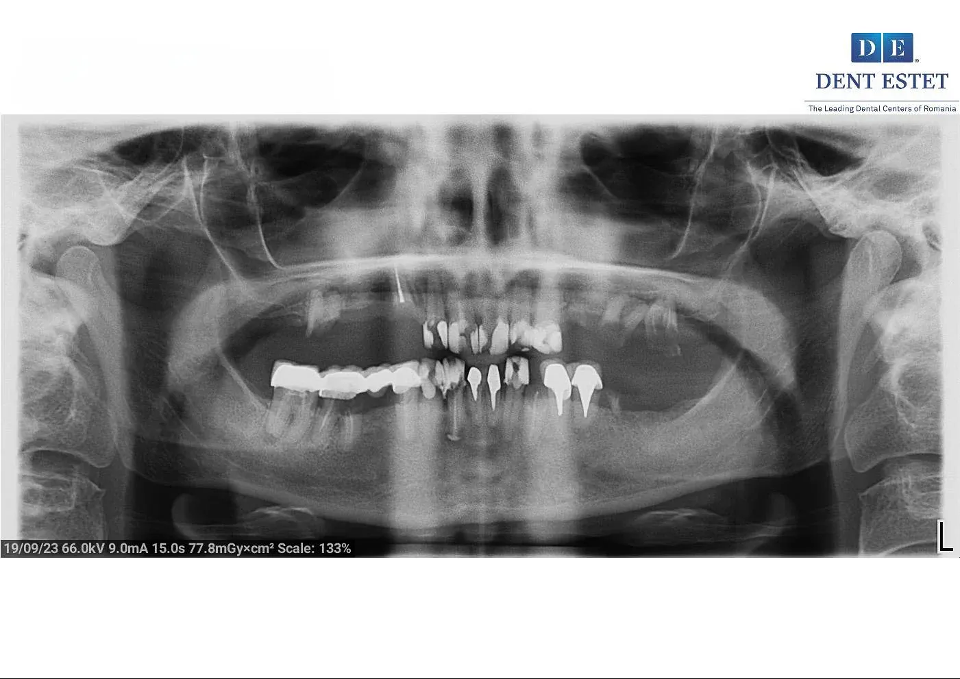 radiografie-inainte.webp