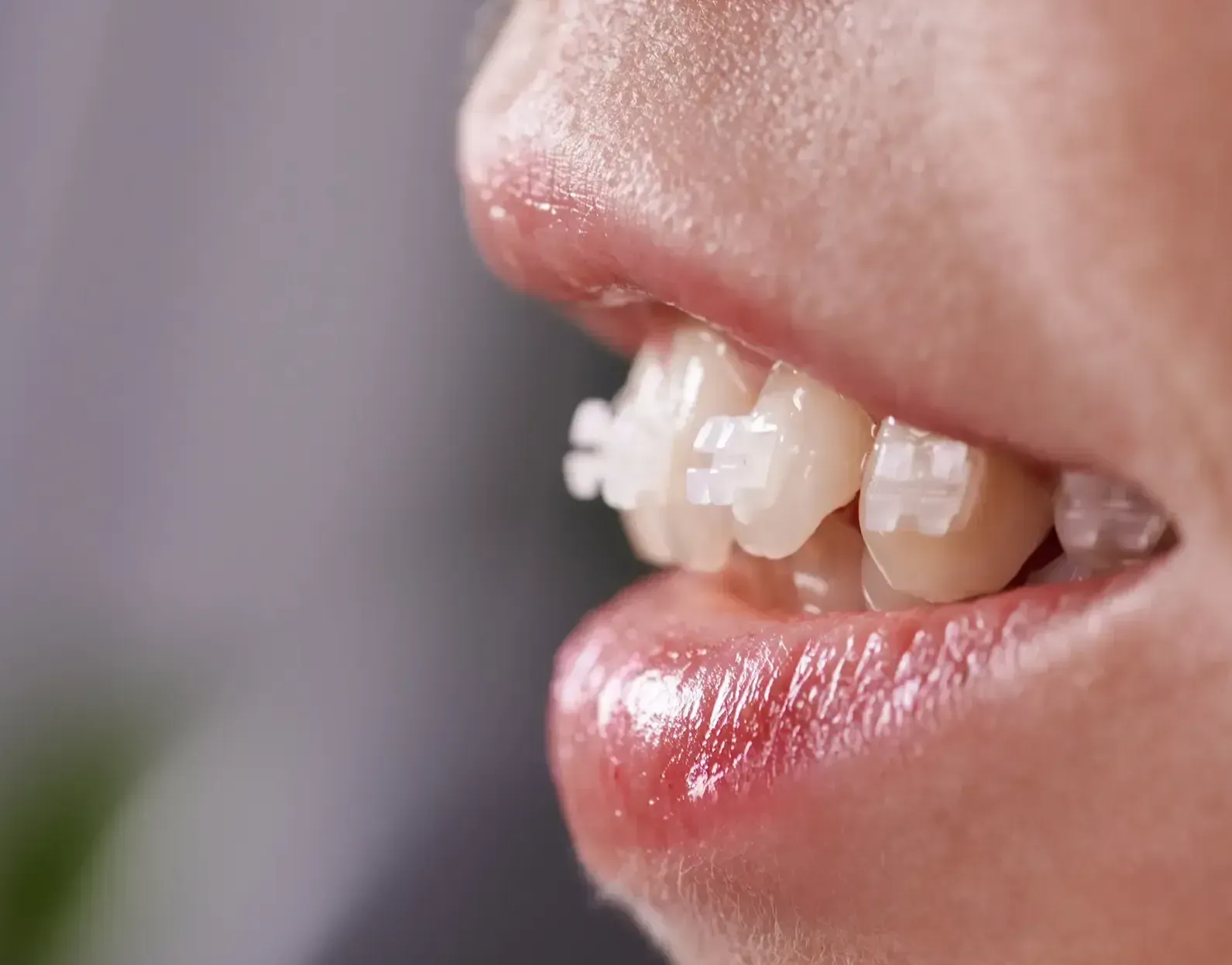 Side view of smile with fixed sapphire braces.